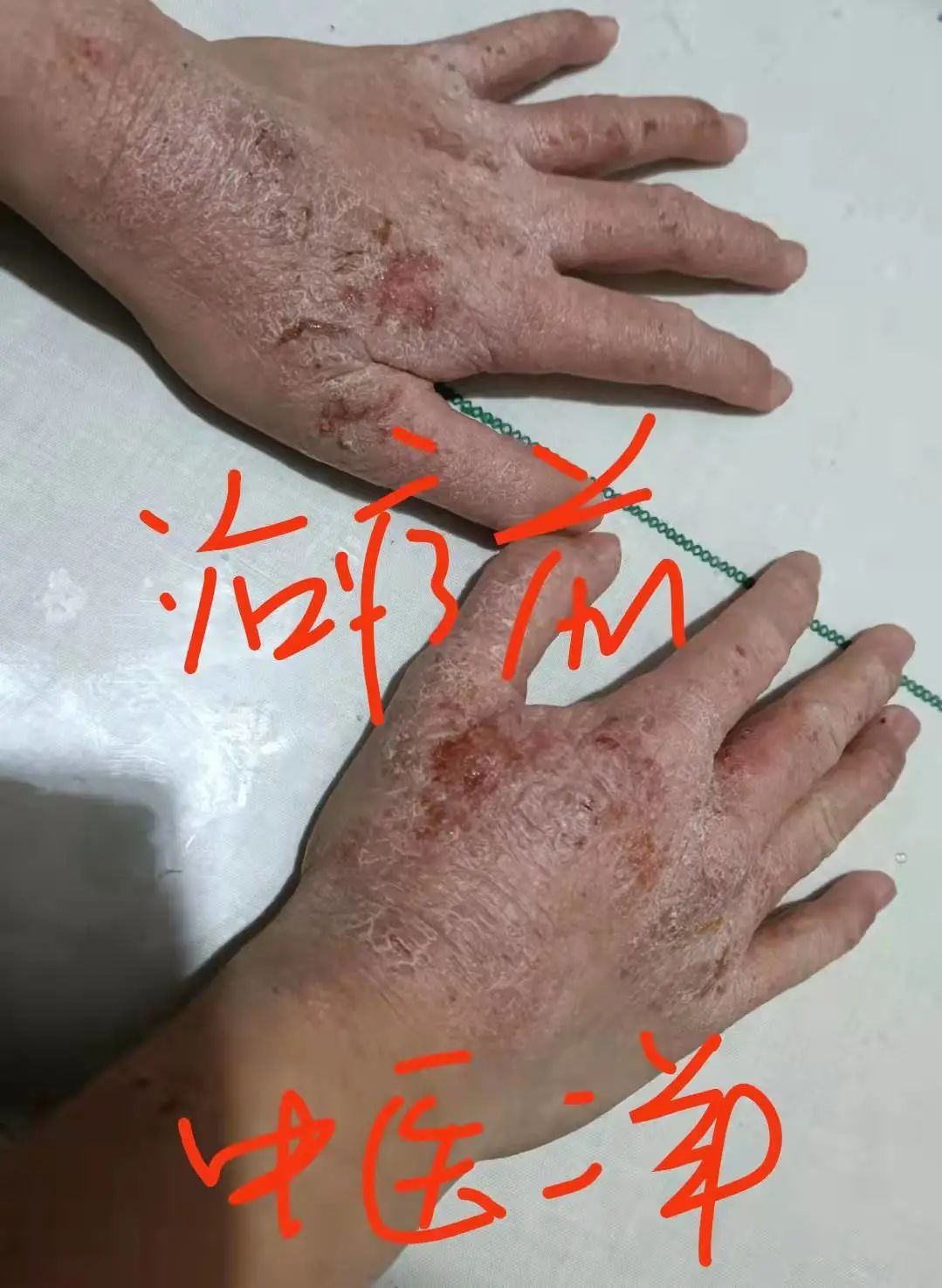11岁小孩顽固性湿疹,病了11年!二羊有幸帮到她除顽疾 11岁小孩顽固性湿疹,病了11年!二羊有幸帮到她除顽疾